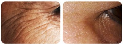 Microneedling (Eyes)